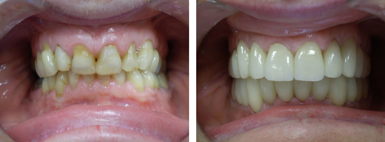 Complete restoration of upper & lower jaw with full ceramic crowns