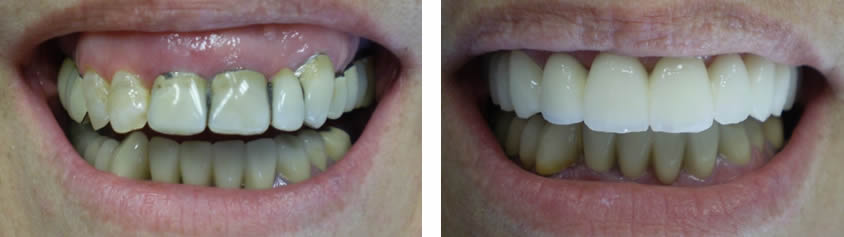 Upper jaw restoration with Zirconium Crowns